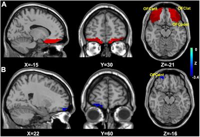 Orbitofrontal Cortex Functional Connectivity-Based Classification for <mark class="highlighted">Chronic Insomnia</mark> Disorder Patients With Depression Symptoms